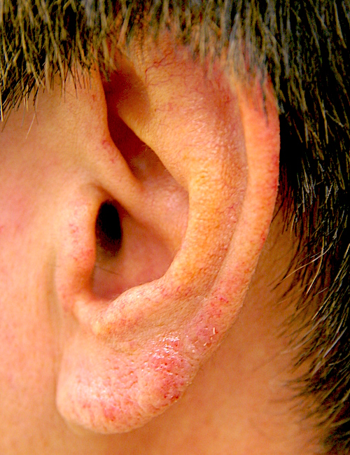 耳の皮膚炎