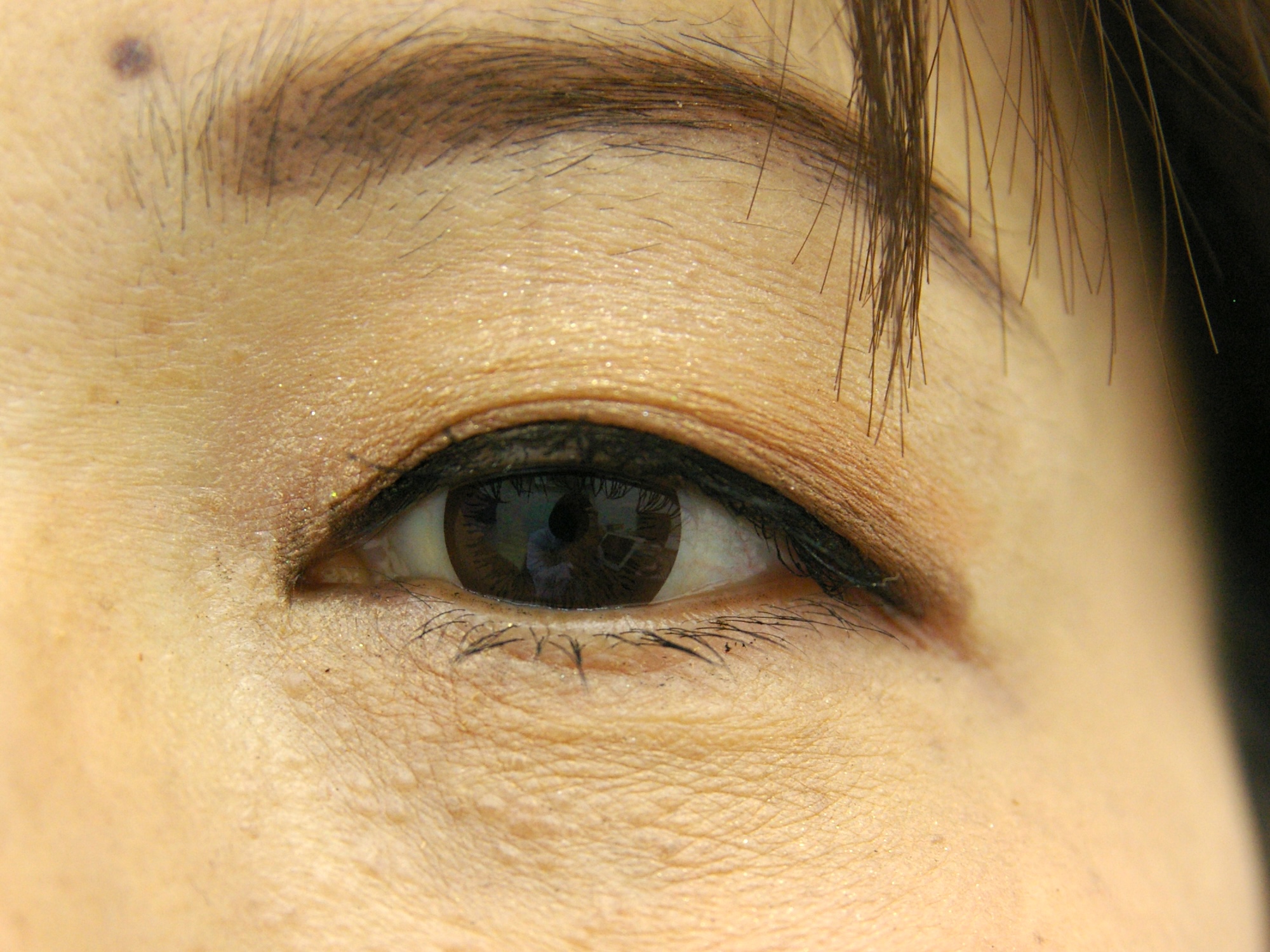 瞼ほくろ術後　大江橋クリニック