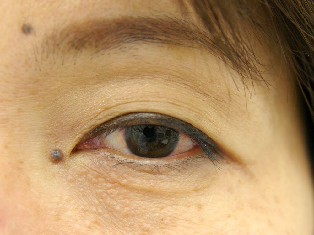 瞼ほくろ術前　大江橋クリニック