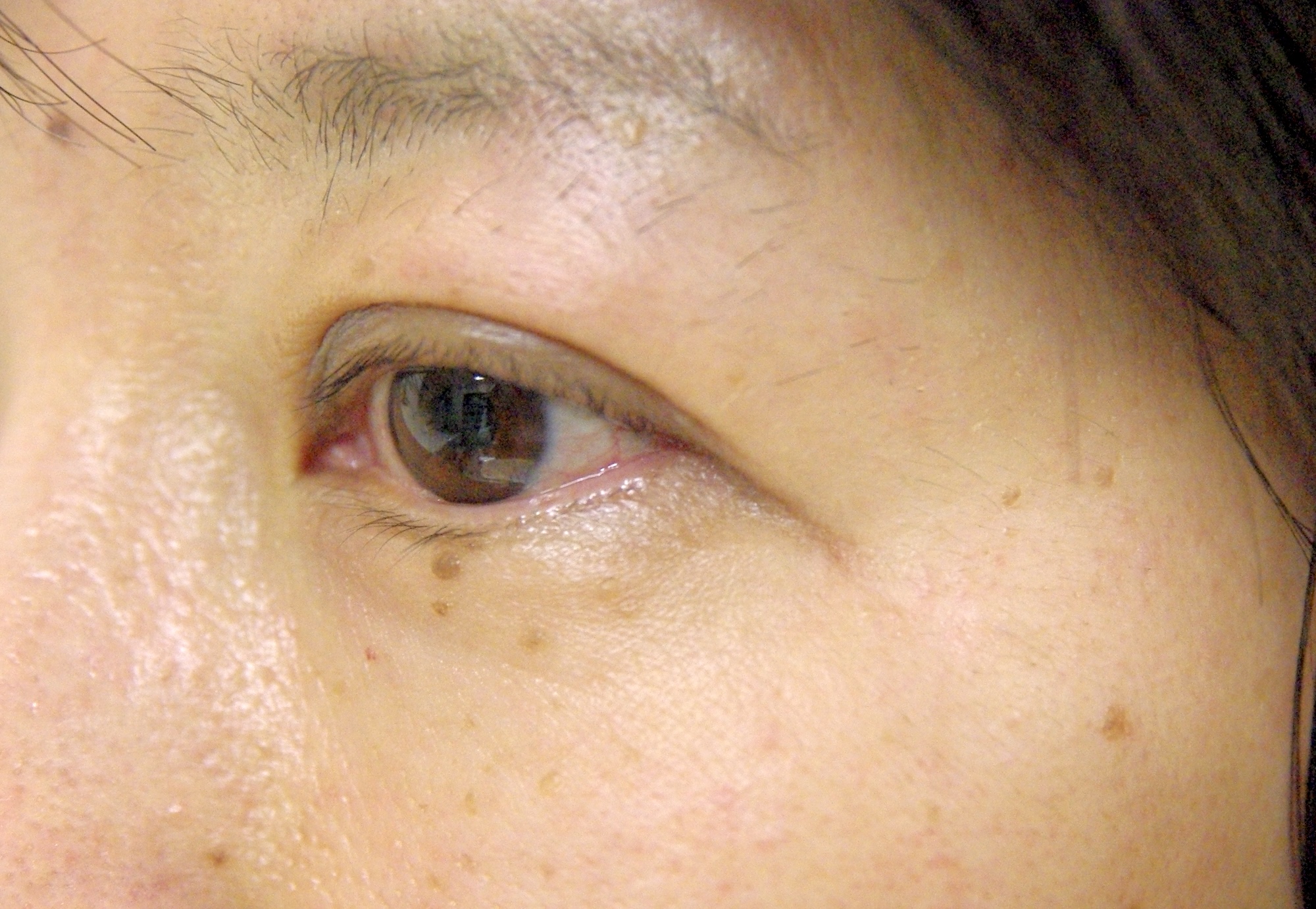 瞼ほくろ術後　大江橋クリニック