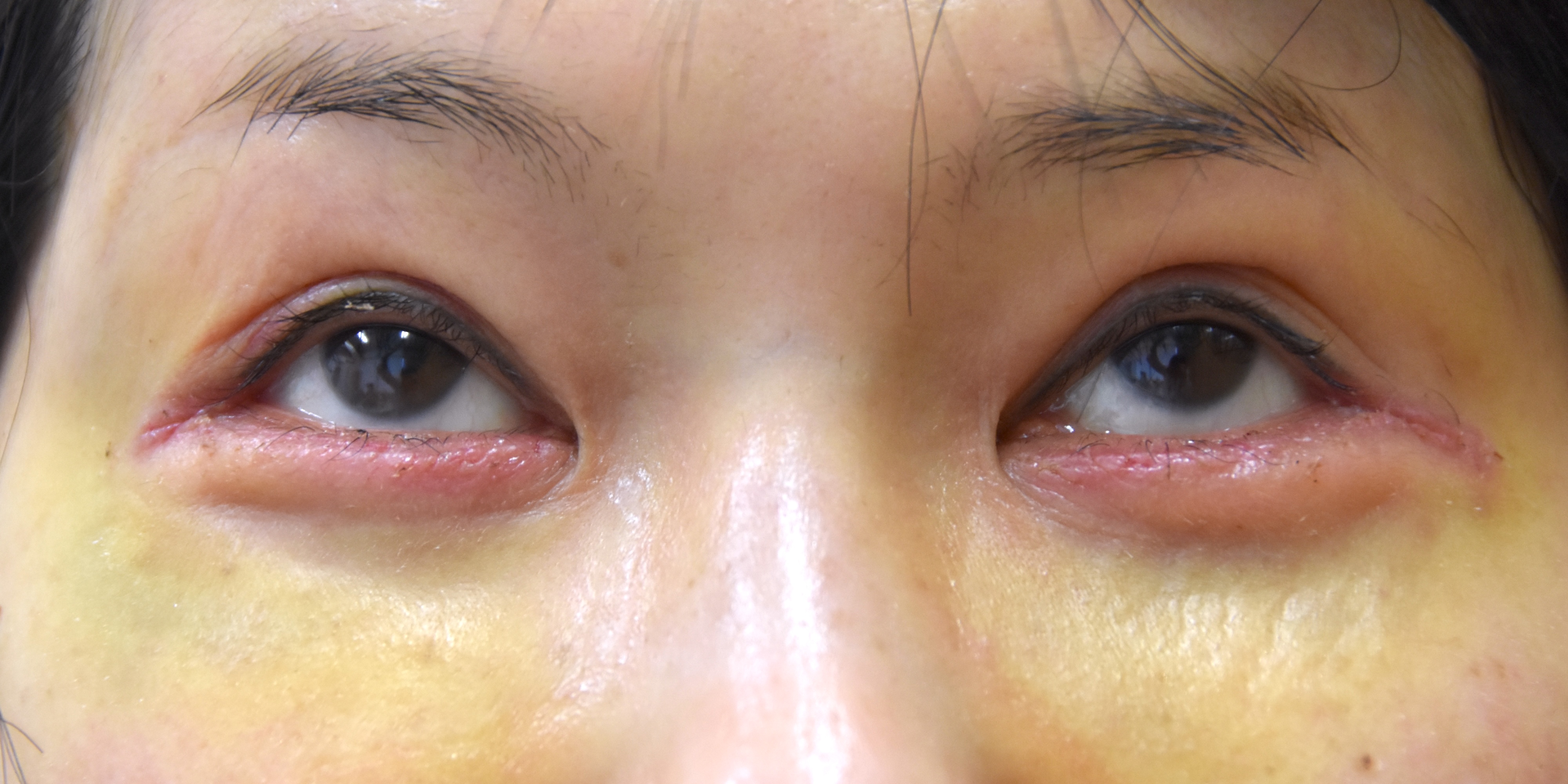 涙堂（涙袋）形成術術後上方視　大江橋クリニック