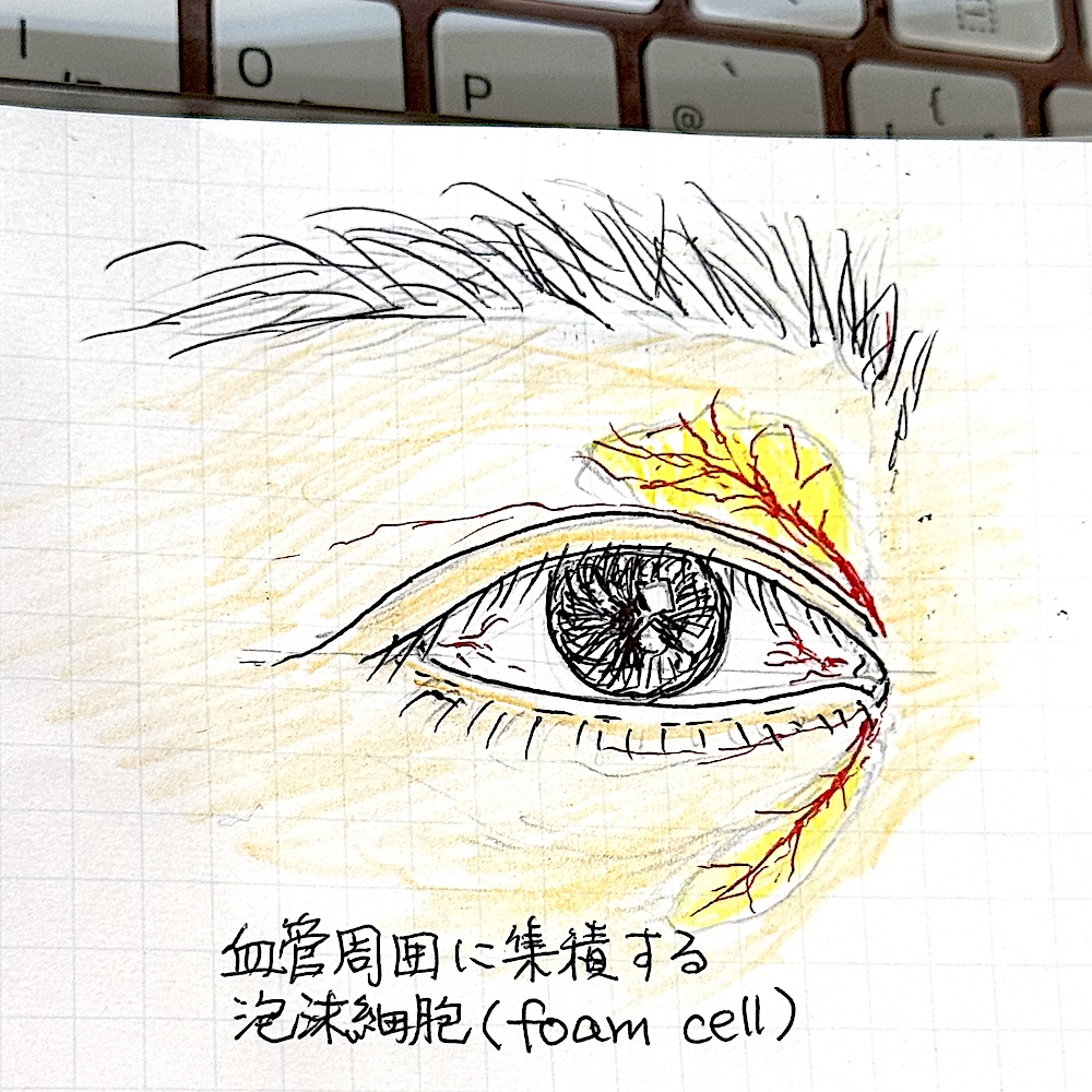 眼瞼黄色腫　大江橋クリニック