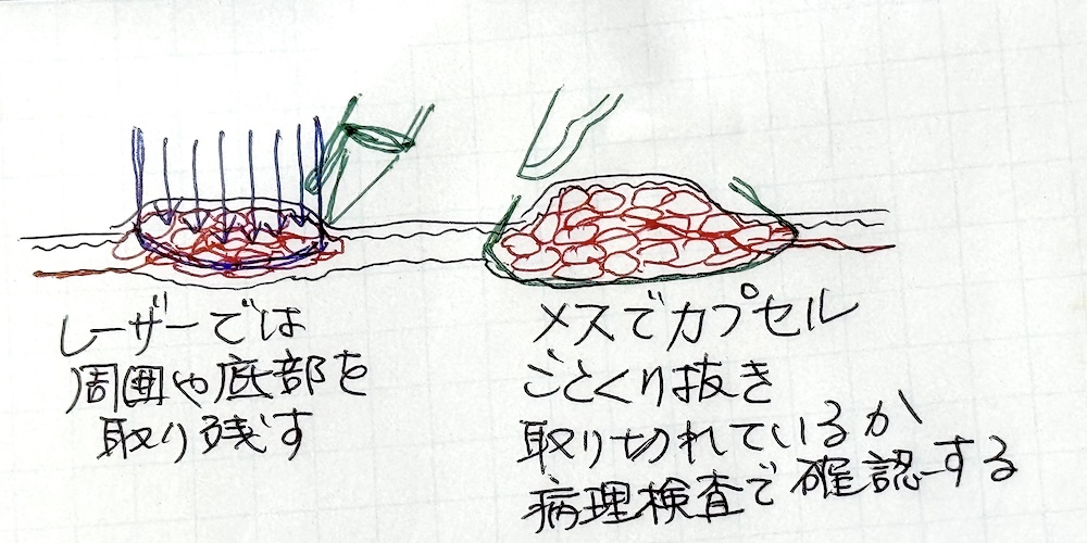 眼瞼黄色腫　大江橋クリニック