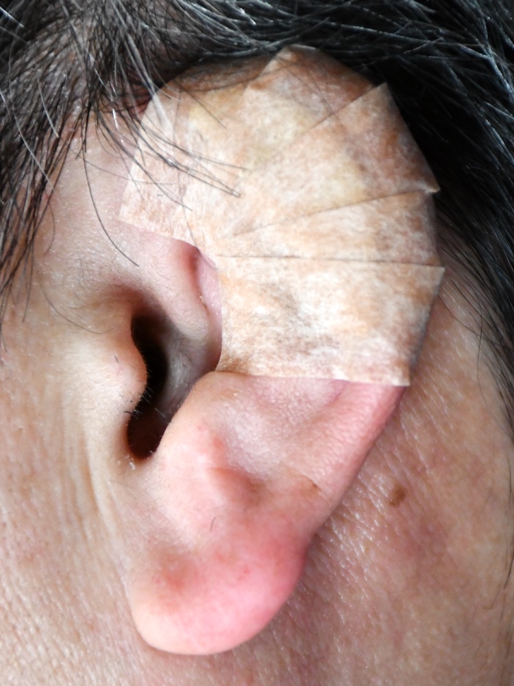 柔道耳術後　大江橋クリニック