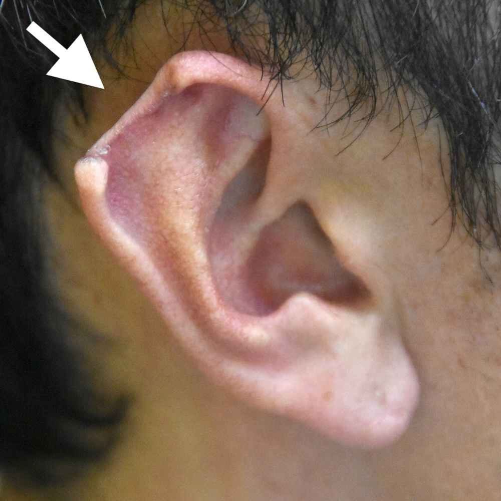 耳介欠損術前　大江橋クリニック