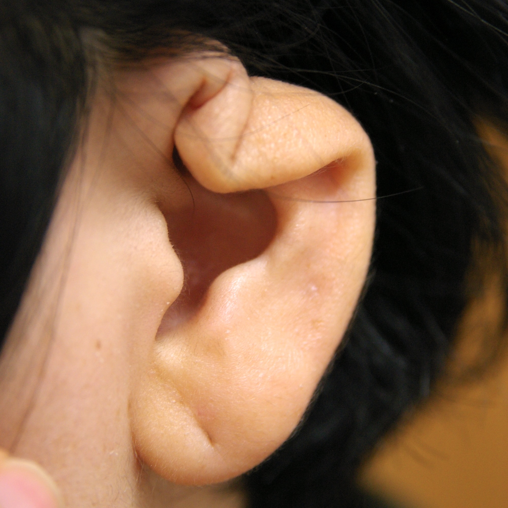 耳介軟骨膜炎後の変形