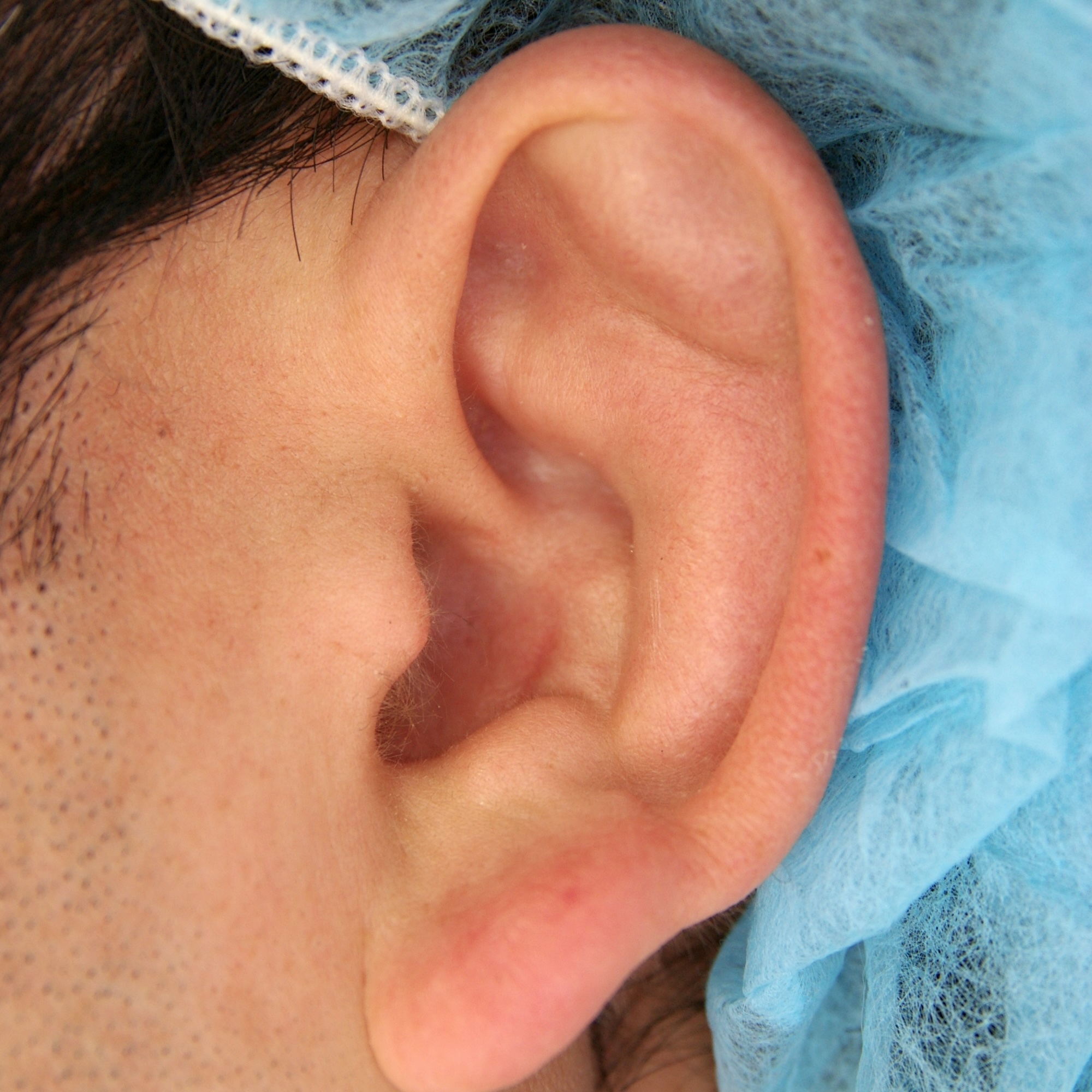 耳介血腫後の変形