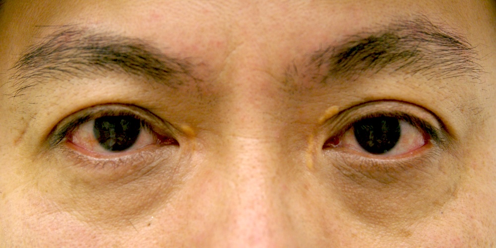 男性眼瞼黄色腫術前　大江橋クリニック