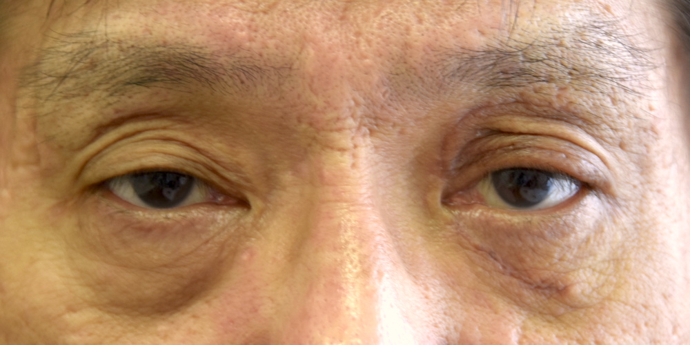 男性眼瞼黄色腫術後　大江橋クリニック