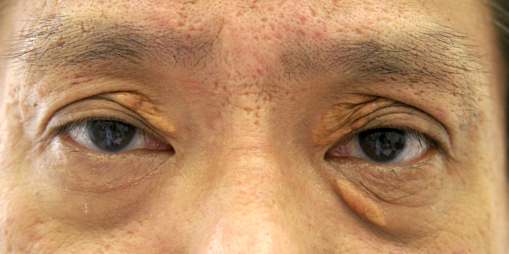 男性眼瞼黄色腫術前　大江橋クリニック