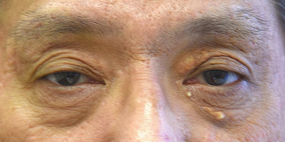 男性眼瞼黄色腫再発術前　大江橋クリニック