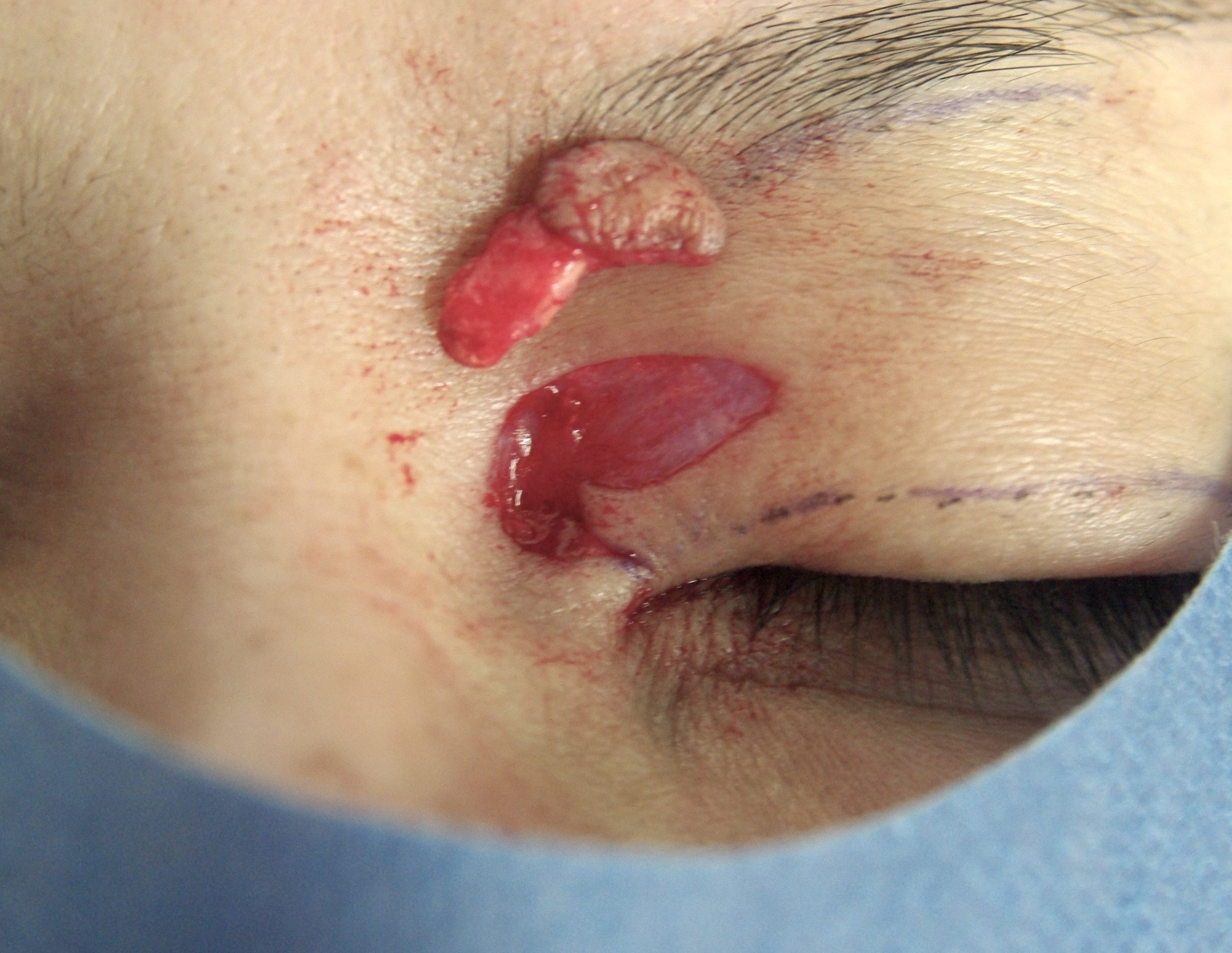 眼瞼黄色腫術中　大江橋クリニック