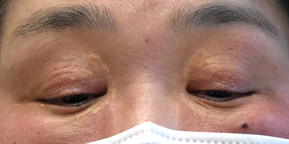 眼瞼黄色腫術前　大江橋クリニック