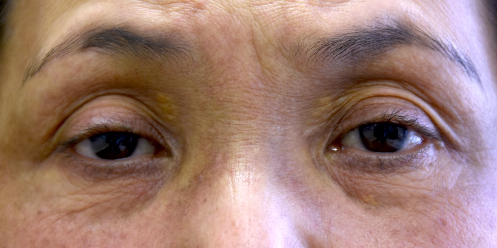 女性眼瞼黄色腫術前　大江橋クリニック